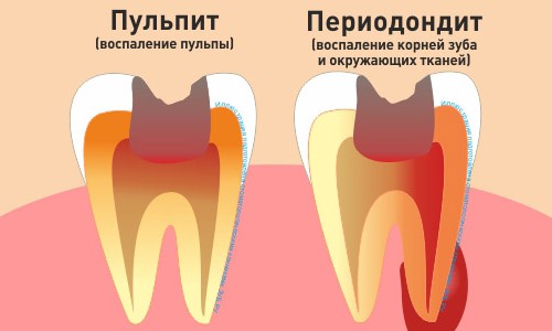 <p>Лечение корневых каналов одного зуба с последующим пломбированием</p>